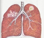 Минздрав успокоил разволновавшихся из-за слухов о тубдиспансере астраханцев